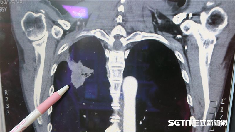 僅「吞嚥不適」沒咳嗽　他竟肺癌晚期