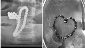 中國浙江5歲男童誤食磁力珠，釀成腸胃穿孔送往加護病房。（圖／翻攝自東網）