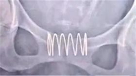 三寶媽「5cm彈簧塞下體」避孕…結果又懷第四胎　醫傻了
圖翻攝自看看新聞