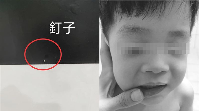 旅館釘子外露！2歲童撞到滿嘴鮮血