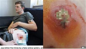 遭毒蛛「假寡婦」夜襲5次 26歲男子傷口潰爛臥床2個月(圖/太陽報)
