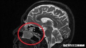 紅框處為鼻竇惡性腫瘤把鼻腔塞滿，導致患者嚴重鼻塞。（圖／南投醫院提供）