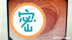 醫師康本初說，病患染幽門桿菌感菌，胃部黏膜表面形成類似「炸雞皮」疙瘩般結節狀變化。（圖／記者楊晴雯攝）