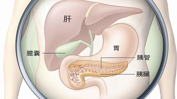 「癌王」胰臟癌AI幫忙抓　2公分無聲殺手現形