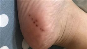 大陸,浙江,腳後跟,黑痣,癌症　圖／翻攝自臉書