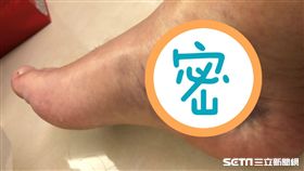 喜歡球類運動者，運動前務必暖身自保，以免導致小腿肌肉撕裂傷，造成「網球腿」的悲劇。（圖／亞大醫院提供）