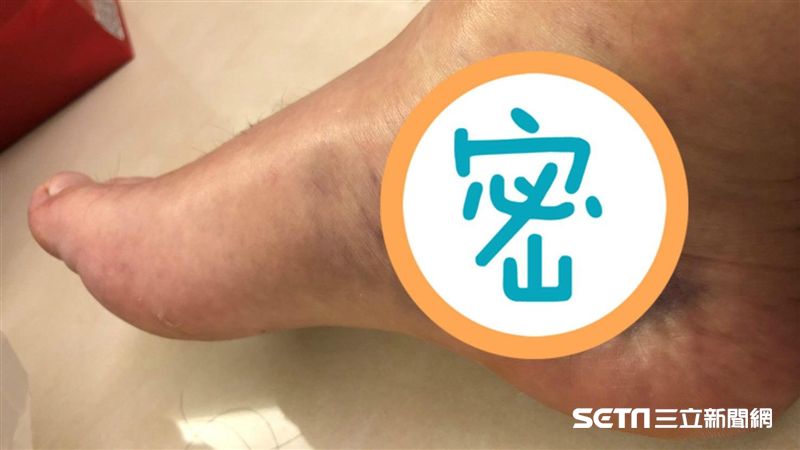趕打球「啪」一聲！他腿痛炸成黑火腿