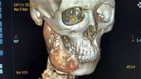 牙痛一年…男下頜被細胞瘤「吃一半」（圖／翻攝自新藍網）