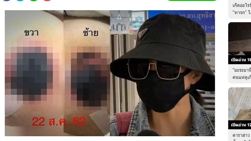 豪乳女縮胸遭切乳X　拆紗布2粒發黑