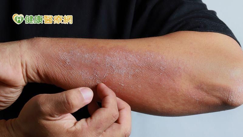 皮膚炎癢別亂抓！小心蜂窩性組織炎