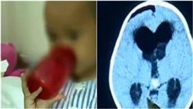 細胞異位！5歲男童狂手抖…醫檢查驚：「頭髮牙齒」長腦內（圖／翻攝自看看新聞）