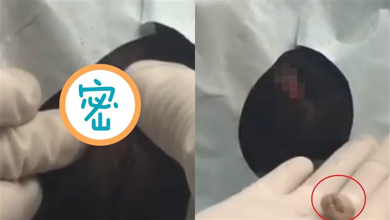 頭皮長超大囊腫　她擠出來瞬間超驚悚