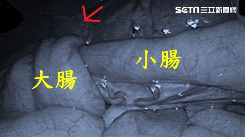 男嬰大便如草莓果醬　醫：這會要命的