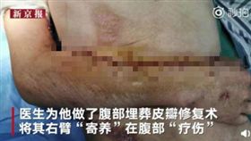中國湖南24歲男子遭遇嚴重車禍，醫師用「寄養」手術，獨特的方式治療。（圖／翻攝自新京報我們 微博)
