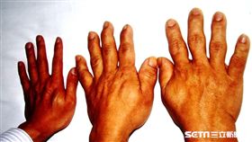 肢端肥大症。（圖／醫師提供）