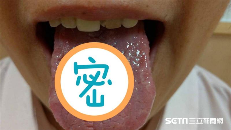 她「這裡」出問題　舌炸裂如輪胎紋！