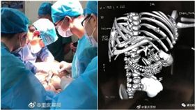 男嬰出生4天就「懷孕」！醫開刀取腫塊…驚見完整頭、手腳（圖／翻攝自重慶晨報）