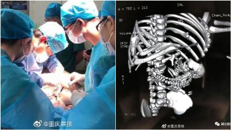 男嬰出生就「懷孕」醫嚇：還有一胎