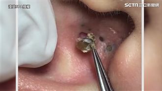 耳朵粉刺比耳屎大　美容師挖出：療癒