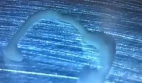 女子身體抽搐兩年！就醫驚見「活蟲吃腦」…1飲食習慣害慘（圖／翻攝自微博）