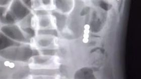 3歲女童吞磁力珠！「腸子吸一團」腹痛狂嘔…手術驚呆醫生（圖／翻攝自微博）