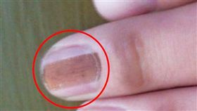 指甲,黑線,台北慈濟醫院,皮膚科,黑色素細胞,黑色素細胞痣,黑甲症,黑色素細胞癌,癌症