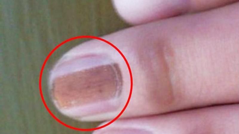 30歲男指甲冒黑線　黑甲症？癌症？