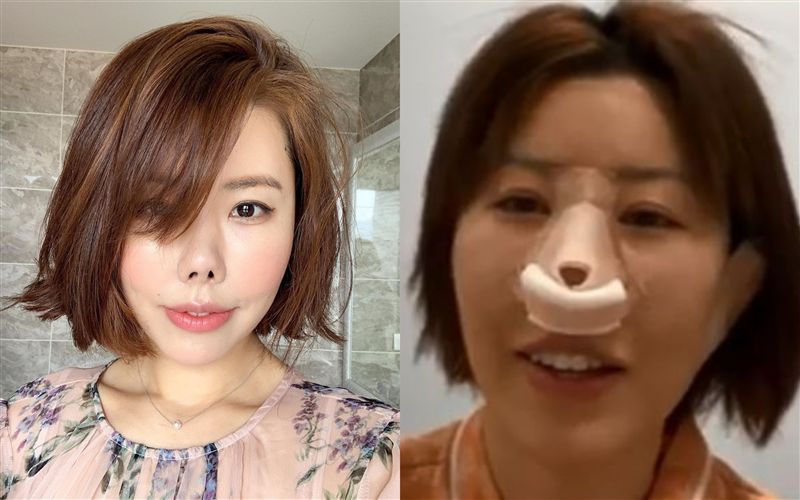 跌倒摔成朝天鼻！她等4年術後照曝光