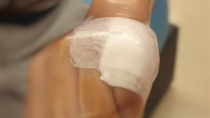 受傷不能碰水　一招「完美套住」大推