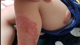 屏東,保母,虐童,社會局,蟹足腫