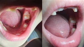 「都沒先告知！」牙醫擅自拔兒乳臼齒　爸聽慘叫聲氣炸：說好只補起來