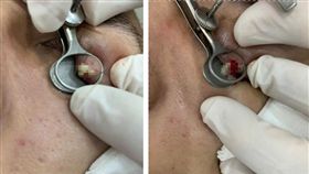 針眼（圖／翻攝自「爆廢公社二館」）