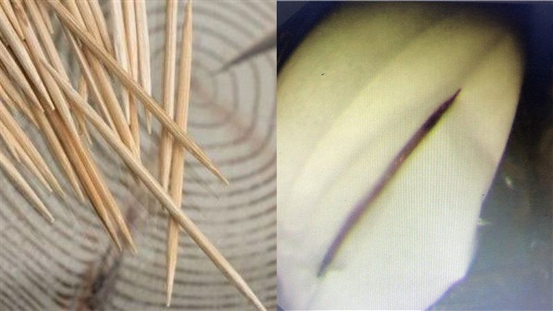 男叼牙籤睡著　半年後胃被刺破險死