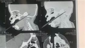 邊吃邊玩！1歲半女童嘴含筷子突跌倒...下秒整根「直插腦後」(圖/翻攝自微博)