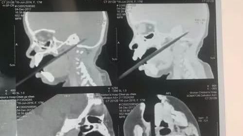 童邊吃邊玩跌倒！筷子刺穿腦袋超驚悚