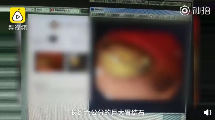 空腹吃芒果長結石！醫囑：喝可樂溶解
