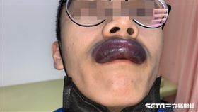 一名男大生在打籃球時不慎被朋友的手肘撞傷，隔天早上睡醒後發現雙唇腫大還變色。（圖／賴昕隄醫師提供）
