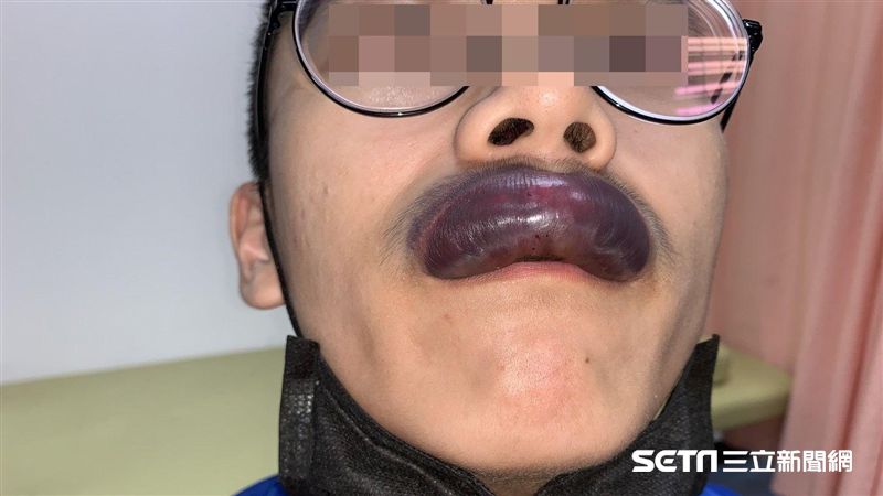 男大生打籃球遭肘擊！慘變「香腸嘴」