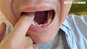 衛生福利部,台北醫院,耳鼻喉科,李家萱,口腔癌
圖／台北醫院、資料照