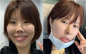 金老佛爺拿下口罩，展現了鼻子剛拆線、拆繃帶後的最新狀況／整容／手術／假體。翻攝自IG