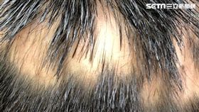 鬼剃頭（黃毓惠醫師提供）