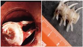 2公分魚骨卡喉嚨…老伯痛爆！醫竟要他「吞手套」
圖／翻攝自北青網