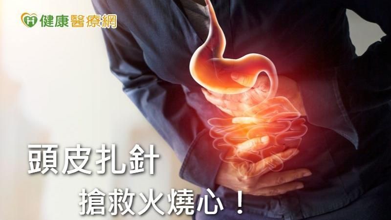 火燒心不見了！一根針治好胃食道逆流