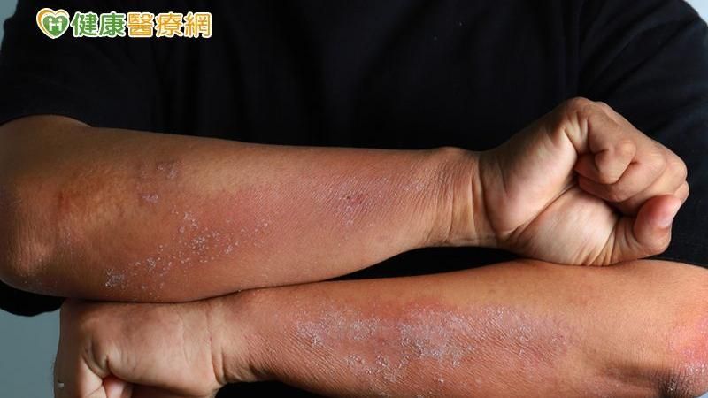 大學生飽受皮膚炎所苦　癢到一度休學