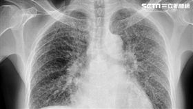 亞洲大學附屬醫院,胸腔內科,林育生,矽肺症
圖／亞大醫院提供