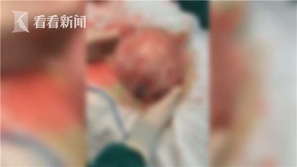 女挺肚以為懷孕…籃球大肉瘤撐爆子宮