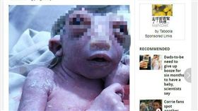 ▲半頭女嬰。（圖／翻攝自《Mirror》）http://www.mirror.co.uk/news/world-news/miracle-baby-born-half-head-7230861