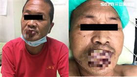 唇癌，腫瘤，膿包，潰爛，發臭（圖／衛生福利部南投醫院提供）