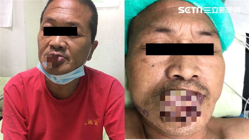 男下唇長「紫色膿包」醫驚：第四期了