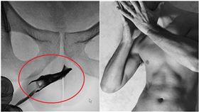 22歲男「拿鑷子塞尿道」！醫問了才鬆口：已經4年了…（圖／翻攝自Science Direct）https://www.sciencedirect.com/science/article/pii/S2214442019300154